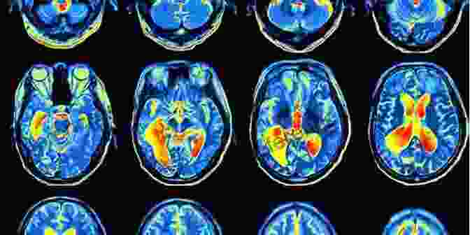 Brain Scan Showing Regions Associated With Aggression Neurobiopsychosocial Perspectives On Aggression And Violence: From Biology To Law Enforcement (Advances In Preventing And Treating Violence And Aggression)