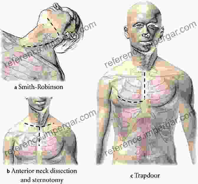 Cervical Approach To The Thoracic Cavity Thoracic Surgery: Cervical Thoracic And Abdominal Approaches