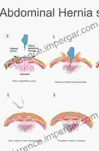 Techniques Of Abdominal Wall Hernia Repair