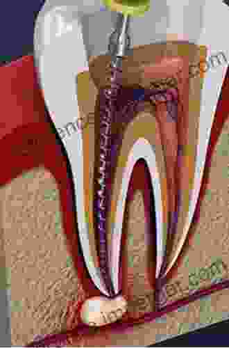 The Root Canal Anatomy In Permanent Dentition